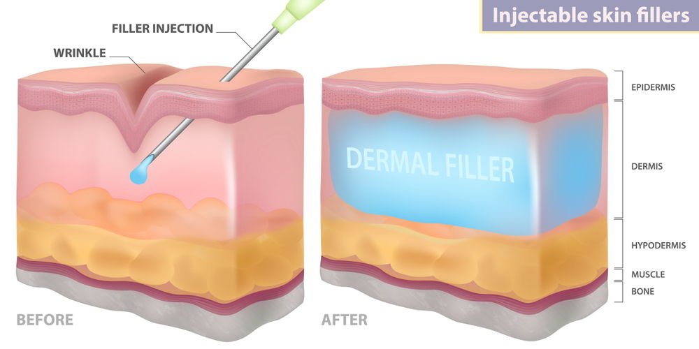 Dermal-Fillar-1