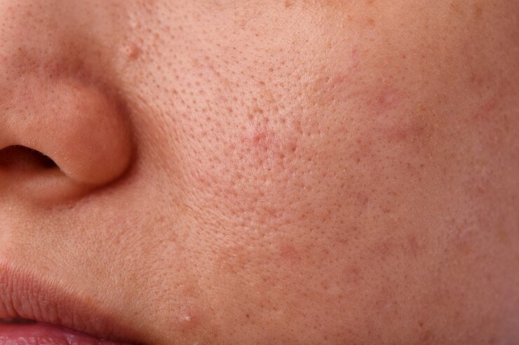 Open Pores