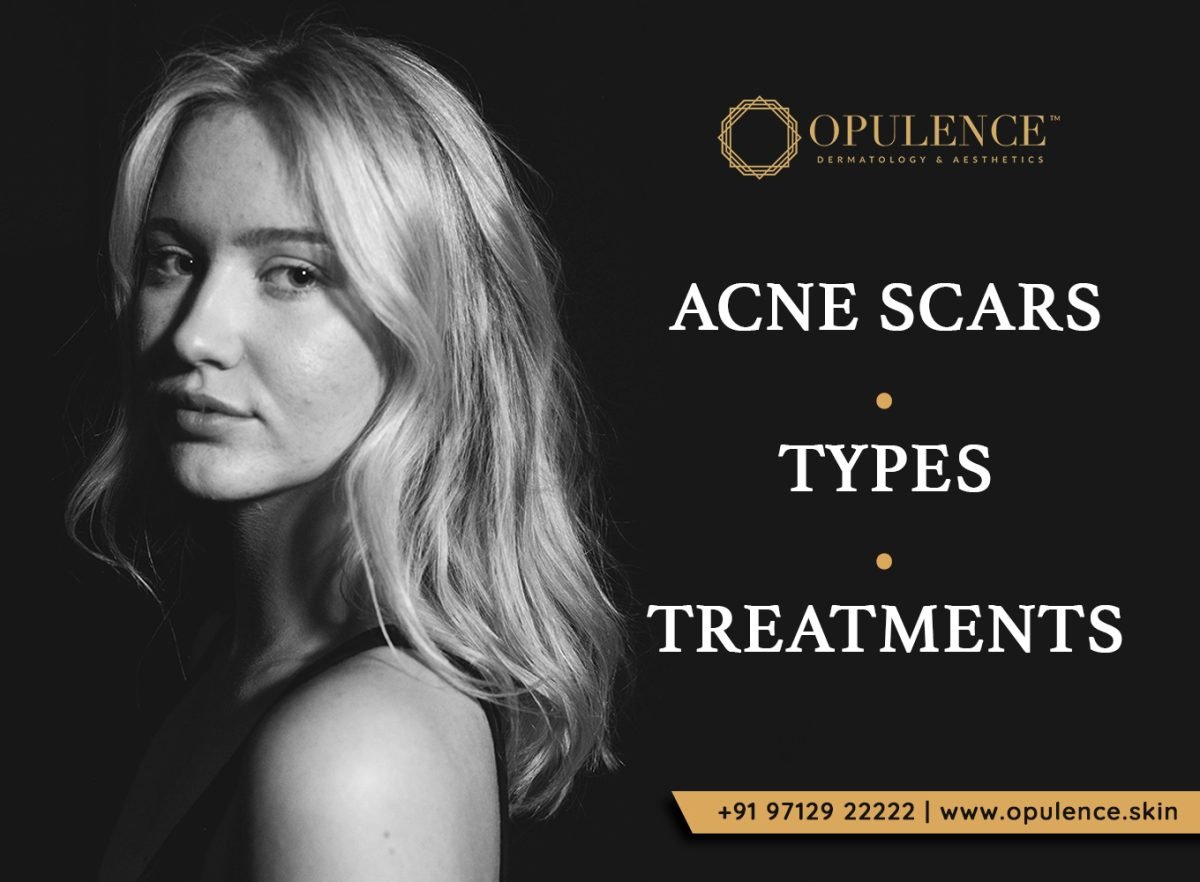 ACNE SCARS. TYPES. TREATMENT | Opulence Dermatology & Aesthetics