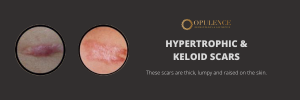 HYPERTROPHIC & KELOID SCARS