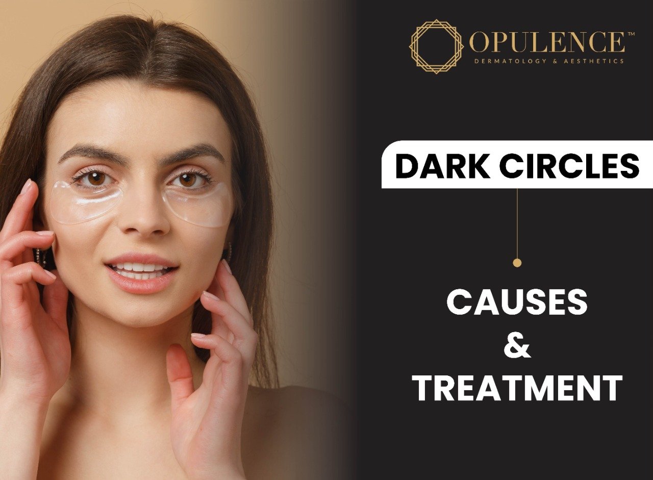 DARK CIRCLES: CAUSES AND TREATMENT